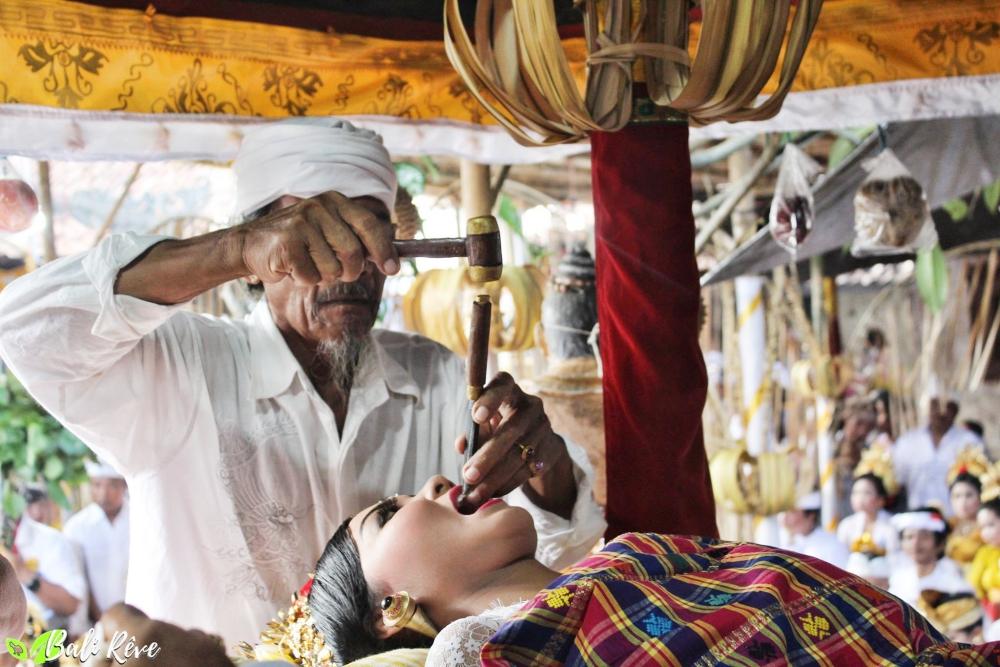 Le limage des dents à Bali : âme et sourire embellis !